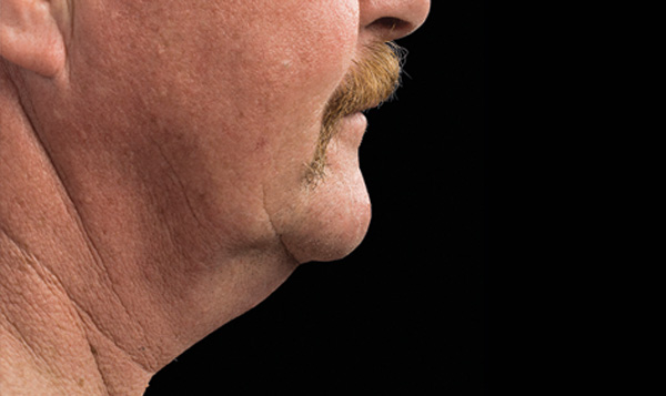 double chin reduction treatment coolsculpting soho nyc manhattan